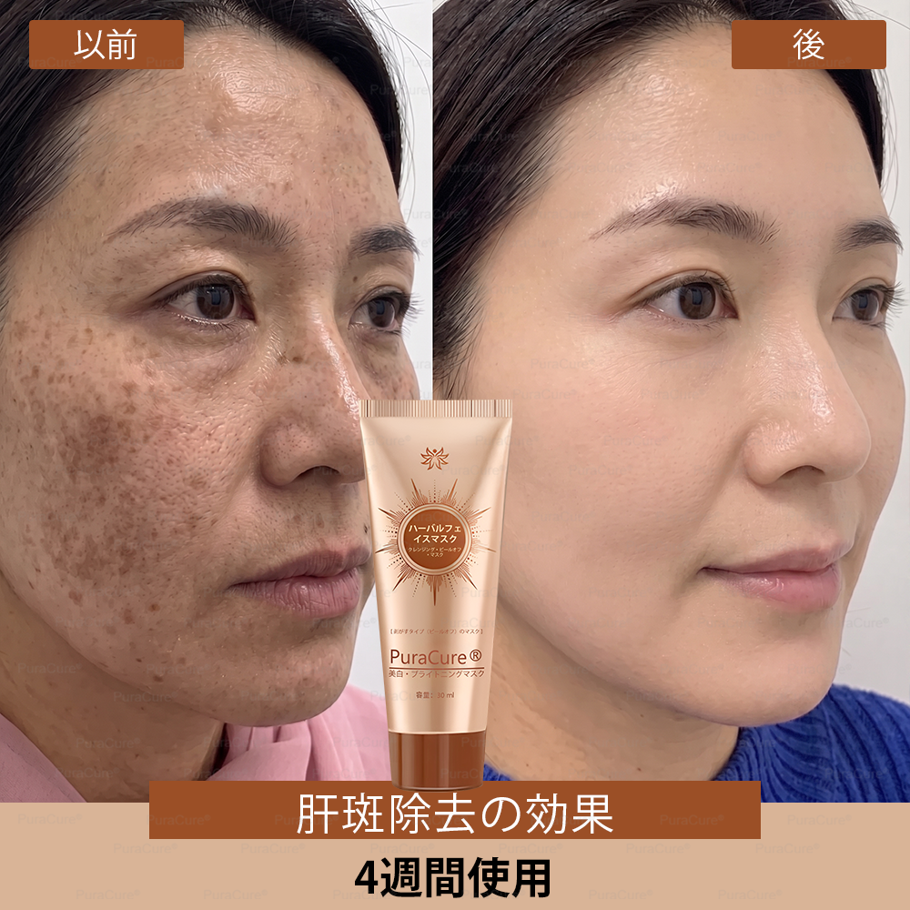 🏵️PuraCure® 美白・スポットケアフェイスマスク【顔・ボディ兼用】天然由来成分配合で、シミ・そばかす・日焼けによるシミを長期間ケア✨