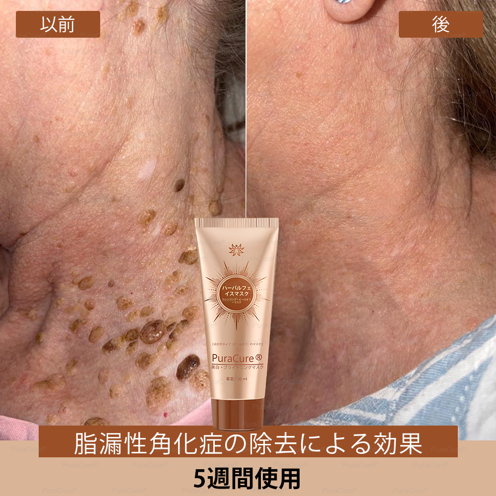 🏵️PuraCure® 美白・スポットケアフェイスマスク【顔・ボディ兼用】天然由来成分配合で、シミ・そばかす・日焼けによるシミを長期間ケア✨